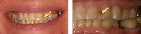 How much will it cost for a repair? realself.com, 14 sept. But Doc Can T You Just Fix My Broken Tooth Spear Education