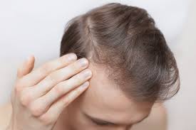 According to the academy of dermatology, it's perfectly normal to lose 100 or so hairs from your head every day. Hair Loss And Ferritin Deficiency Trichology