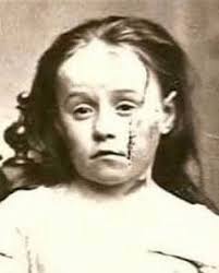 Beaten, starved and humiliated — these were the first ten years of Mary  Ellen Wilson, born in 1864 in New York. Orphaned and abandoned, the little  one was adopted by Mary and