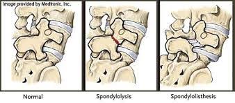 Low Back Pain In The The Sport Of Gymnastics