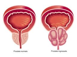 > cacciagione, carne di maiale, insaccati. Prostatite Sintomi Cause Tutti I Rimedi Cure Naturali It