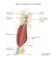 There are five major shoulder bones. Biceps Tendon Tear At The Shoulder Rehab My Patient