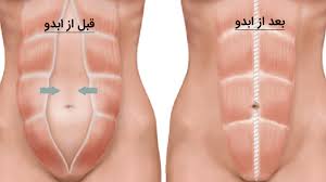 بعد از عمل بالن معده چی بخوریم+ابدو یا ابدومینوپلاستی چه عملی است+لیپوساکشن چگونه است+آیا عمل لیپوماتیک بیهوشی دارد