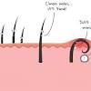 Ingrown hairs occur when hair curls around and grows back into the skin or if dead skin clogs the hair follicle and forces it to grow sideways. 3
