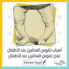 أسباب تقوس الساقين عند الأطفال علاج تقوس الساقين عند الأطفال شخابيط