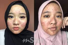 Tengok Testimoni Pengguna Lain Kulit Mereka Jadi Cantik Gadis Selamba Kongsi Foto Muka Penuh Jerawat Selepas Guna Produk Dicadangkan Makcik Viral Mstar