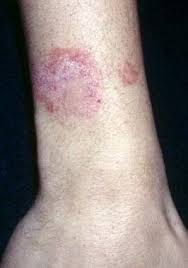 Image result for dermatitis contacta children