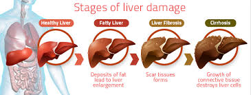Elevated Liver Enzymes in Celiac Disease Can Normalize