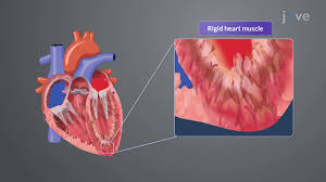Image result for Cardiomyopathy