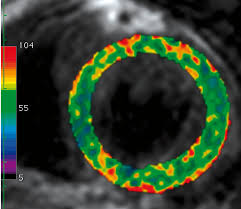 Eingereicht von markus brudniak zur erlangung des akademischen grades doktor der gesamten. Myokarditis Mrt Hat Hochste Sensitivitat Und Spezifitat