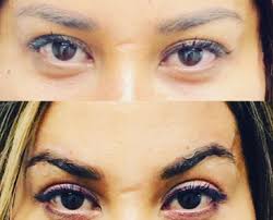Thread lift before and after eyes. Pdo Thread Lift Before And After Agedefymd