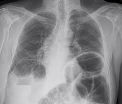 Image result for Adynamic Ileus