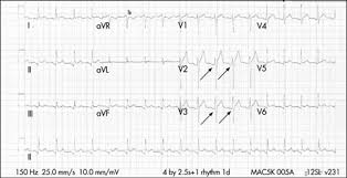 Oh, md samsung professor of cv diseases Pericardite Sintomas Diagnostico E Tratamento Bmj Best Practice