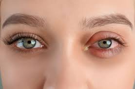 Image result for Conjunctivitis