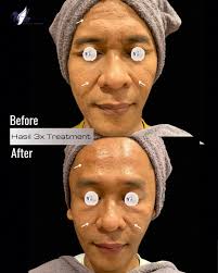 Kulit wajah jadi kelihatan lebih sehat‼️😊 Kerutan dan scar memudar 😍  Konsultasi dan Reservasi Sekarang Yuk ! 📍Cabang Denai Jl. Panglima Denai  No.88M Denai Bisnis Center Kec. Medan Denai 📍Cabang Asrama Haji