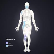 I am afraid you have a fracture. Osteosarcoma Radiology Reference Article Radiopaedia Org