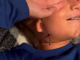 Boy, 10, has to screw jaw forward so he can eat, talk and swallow