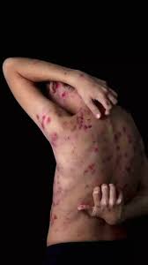 Image result for scabies effects on the human body