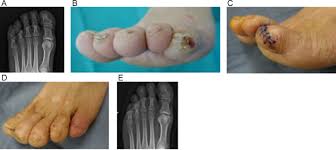 Image result for toe amputation