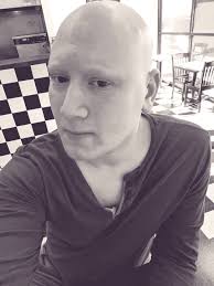 Anyone else developed Alopecia after having Covid?