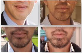 Loading beard's progress after 13 months of minoxidil application. How To Grow A Beard As Asian Without Minoxidil