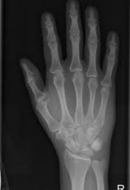 Image result for Pisiform Bone