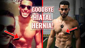 See more ideas about hernia exercises, hernia inguinal, exercise form. How I Treated My Hiatal Hernia Naturally It S Not A Tumor Youtube