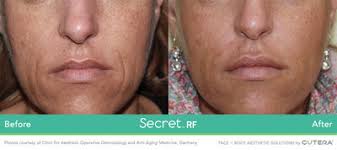 Cutera Enters Two New Aesthetic Markets With Launch Of New Products