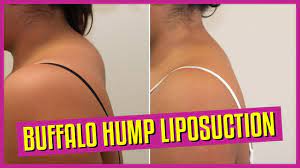 And how to get the min, the max and the. Buffalo Hump Liposuction Youtube