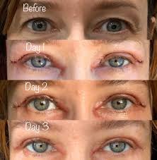 Upper Blepharoplasty Beverly Hills
