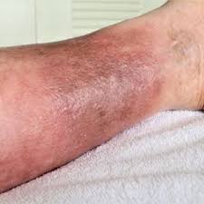 Image result for Stasis Dermatitis