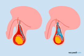 Image result for Varicocele