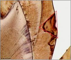 Type of dental caries affecting teeth which are basically caries which has become stationary or. Histopathology Of Caries In Enamel And Dentine Dentalnotebook