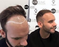 The overall price, in this case, can reach up to ₹ 80,000. Fue Hair Transplant Uk Fue Hair Restoration Costs What Is It Before And After