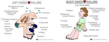 Image Result For Left Sided Heart Failure Vs Right Sided Heart Failure Right Sided Heart Failure Left Sided Heart Failure Heart Failure Symptoms