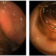 Wang notes that given's pillcam costs $500, significantly less than the roughly $4,000 rate for colonoscopy. Findings By Colon Capsule Endoscopy Pillcam Colon 2 Given Imaging Download Scientific Diagram