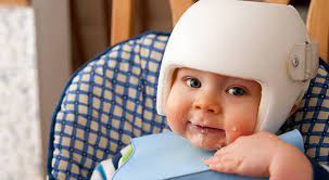 Why Do Babies Wear Helmets Norton Children S Louisville Ky
