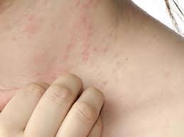 Consejos Para Tratar La Dermatitis De Contacto Cuidateplus