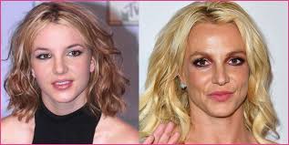 Plastic Surgery Before And After 9 Celebrities On What It S Really Plastic Surgery Before And After Plastic Surgery Celebrity Plastic Surgery Facial Reconstruction Surgery