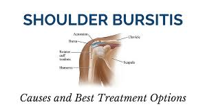 The shoulder is one of the most complex joints of the body as it allows for almost a 360 degree motion. Treating Shoulder Bursitis Niagara Shoulder Pain Clinic