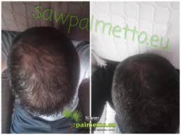 Saw palmetto is an ancient herbal remedy with many benefits. Frequently Asked Questions About Xpecia Saw Palmetto Sale Of Xpecia Original