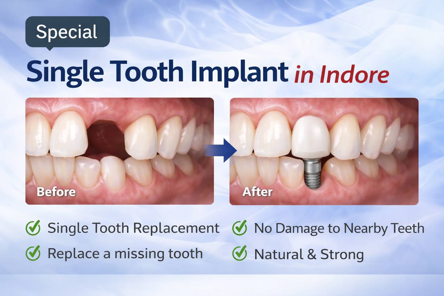 Single Tooth Implant in Indore product image