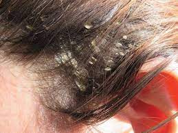 However, since almond oil is rich in all these minerals, applying the oil regularly will help thwart hair loss and encourage new hair growth feeding them to. 5 Viable Benefits Of Almond Oil For Hair You Need To See Lewigs