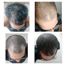 The truth is, hair loss is out of your control. I M Balding Its Been Month On Min Fin Hairloss
