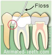Learn everything you need to know about sinus problems after a root canal from sarasota bay dental now. What To Expect After Root Canal Treatment Post Op Pain Aftercare Precautions