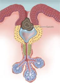 Image result for Sialolithiasis