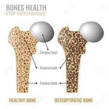 Vector illustration scheme of bone cross section. Osteoporosis Cross Section Image Osteoporosis Bone And Healthy Royalty Free Cliparts Vectors And Stock Illustration Image 91375518