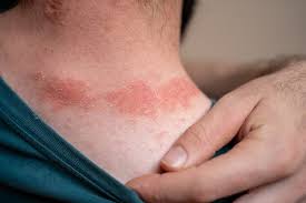 Image result for psoriasis