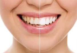 Biaya membersihkan karang gigi bisa berbeda tiap klinik dan tergantung tingkat keparahan karang gigi. Ø²ÙˆÙ„ÙØ¶Ù„ÙŠ Ø²ÙŠÙ† On Twitter Pagi Ni Nak Sharing Pasal Teeth Whitening Atau Putihkan Gigi Di Klinik Berdaftar Aku Tahu Ramai Betul Berminat Dan Teringin Nak Buat Whitening Ni Aku Share Sedikit Benda