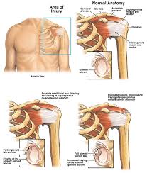What Settlement Can You Expect If You Injured Your Rotator Cuff In A Car Accident Blasingame Burch Garrard Ashley P C